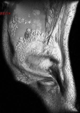 Figure 4 for case Lipoma arborescens
